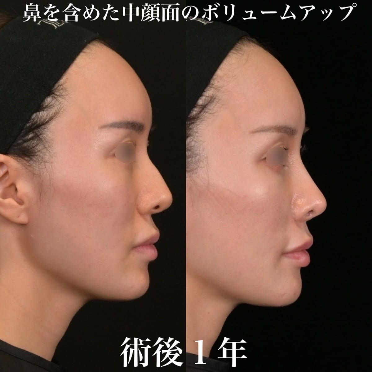 鉄医師による鼻整形の術前/術後1年 بعد 