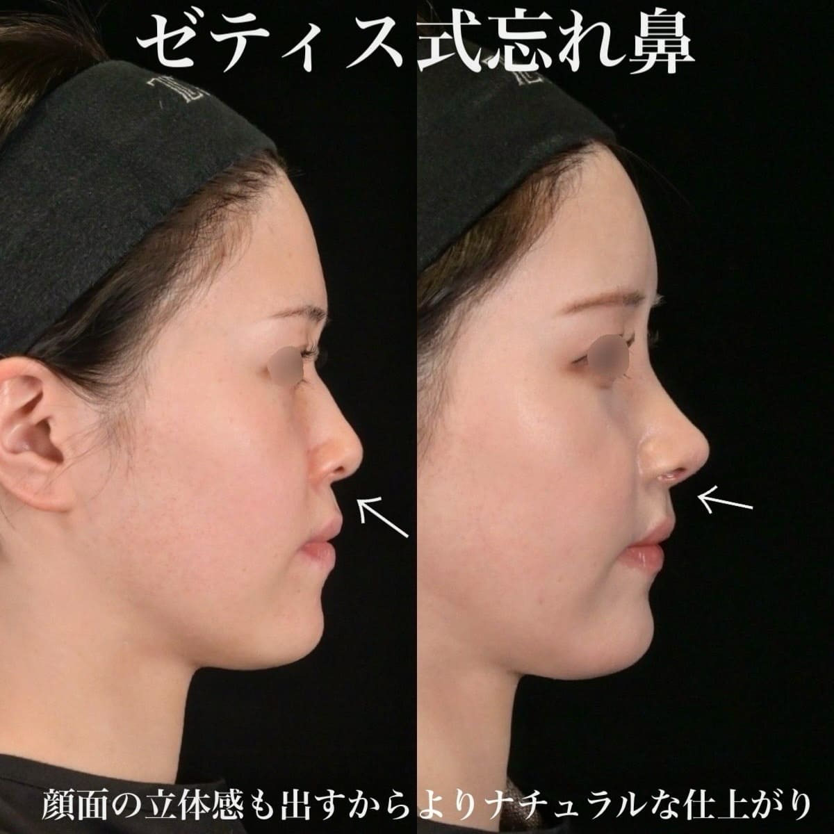 鉄医師による鼻整形の術前/術後1ヶ月