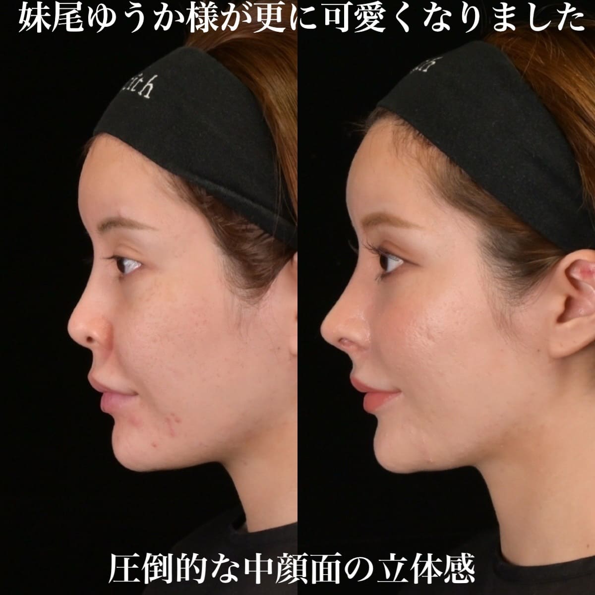 鉄医師による鼻整形の術前/術後1ヶ月 施術後 