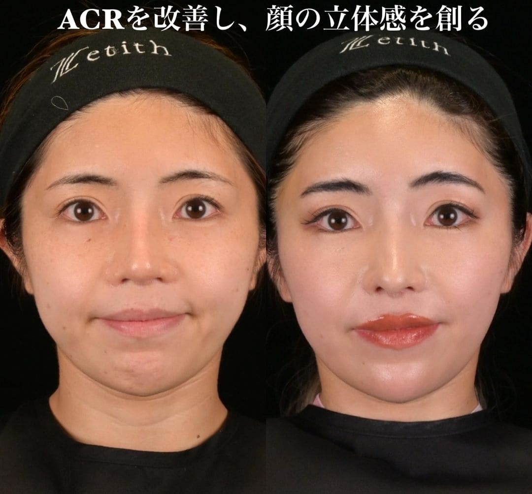 鉄医師による鼻整形の術前/術後3ヶ月 施術後 