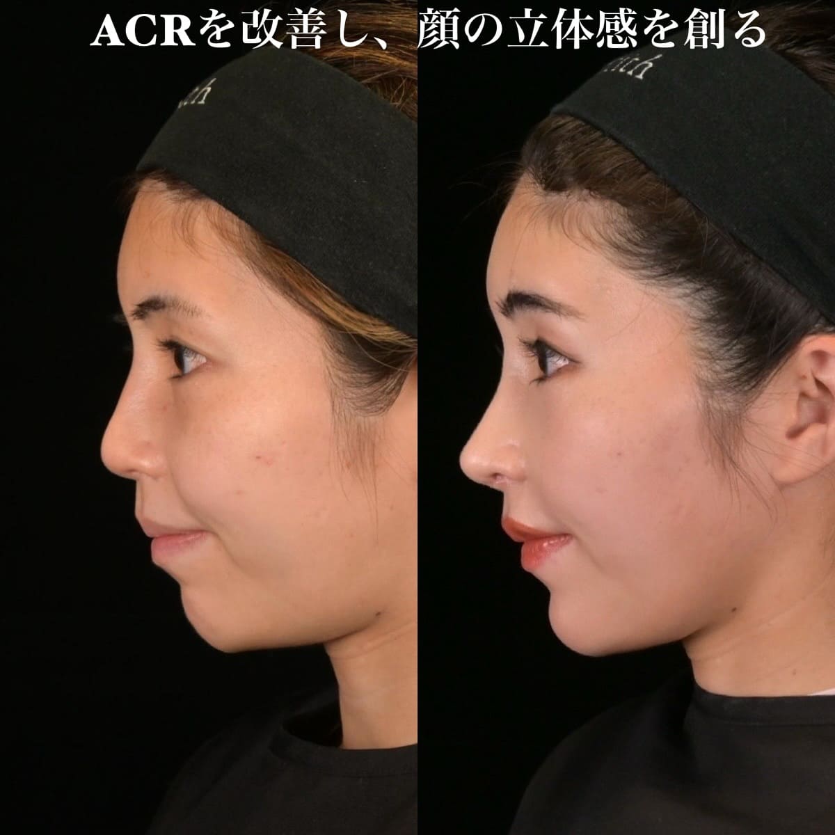 鉄医師による鼻整形の術前/術後3ヶ月