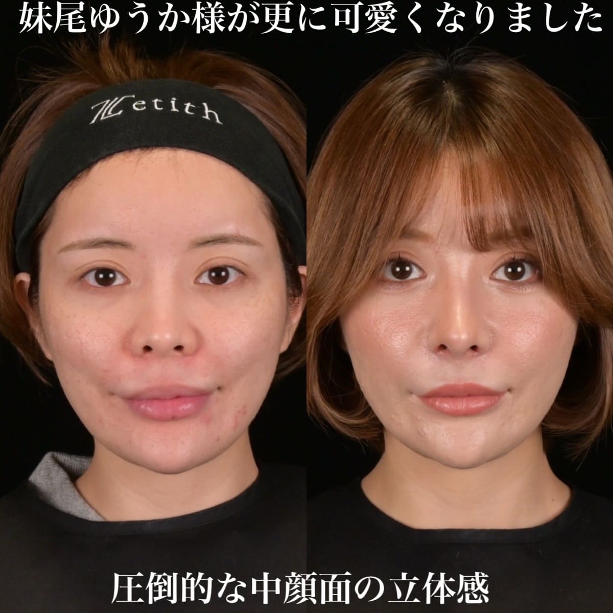鉄医師による鼻整形の術前/術後1ヶ月