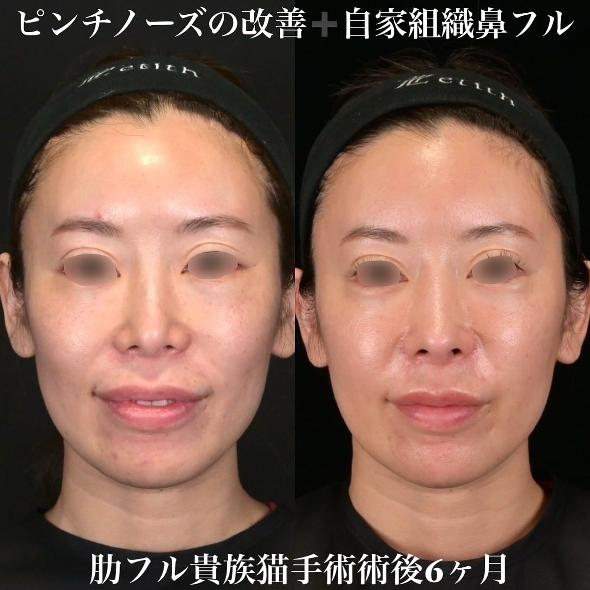 鉄医師による鼻整形の術前/術後6ヶ月