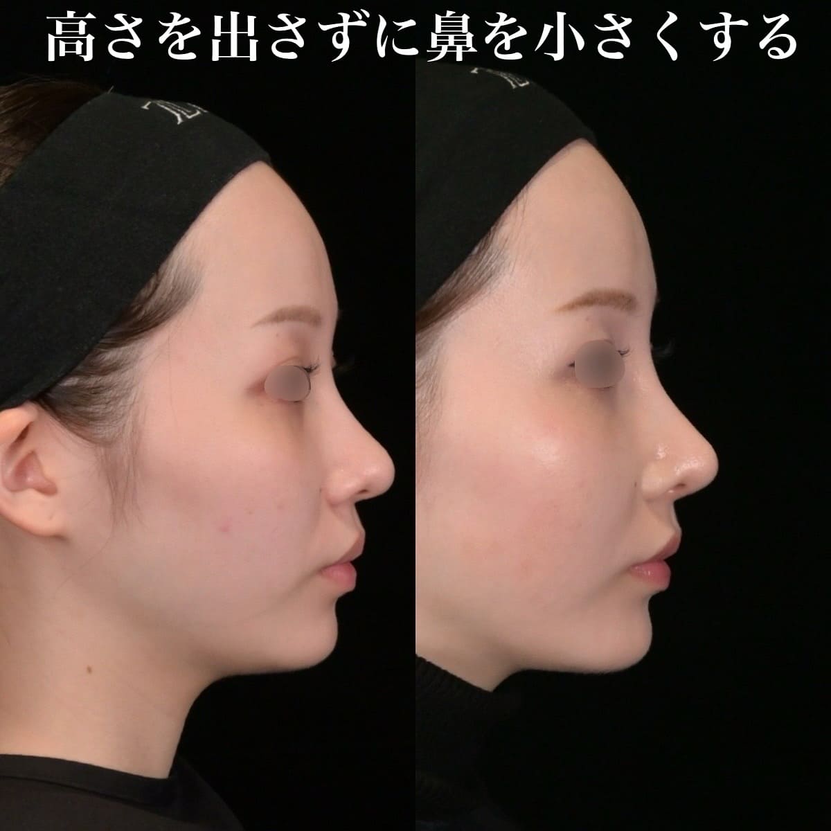 鉄医師による鼻整形の術前/術後3ヶ月 施術後 