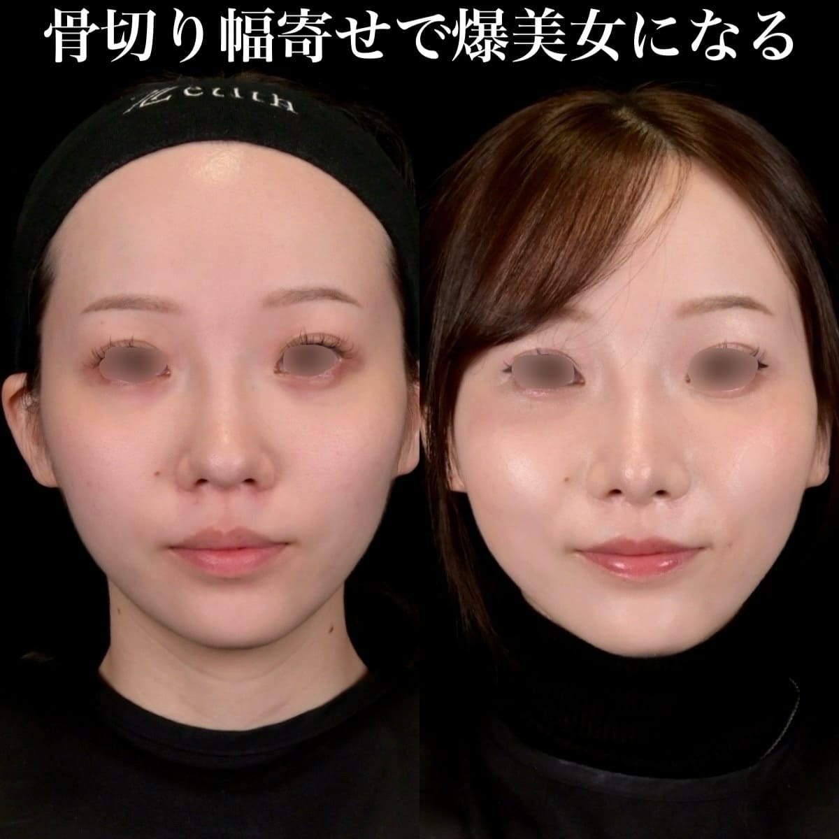 鉄医師による鼻整形の術前/術後3ヶ月