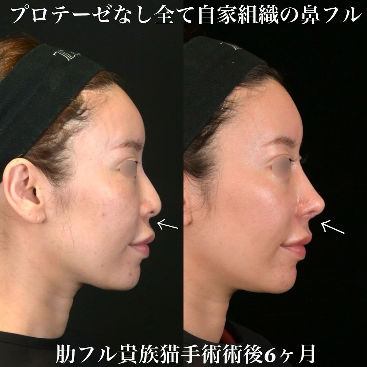 鉄医師による鼻整形の術前/術後6ヶ月 术后 