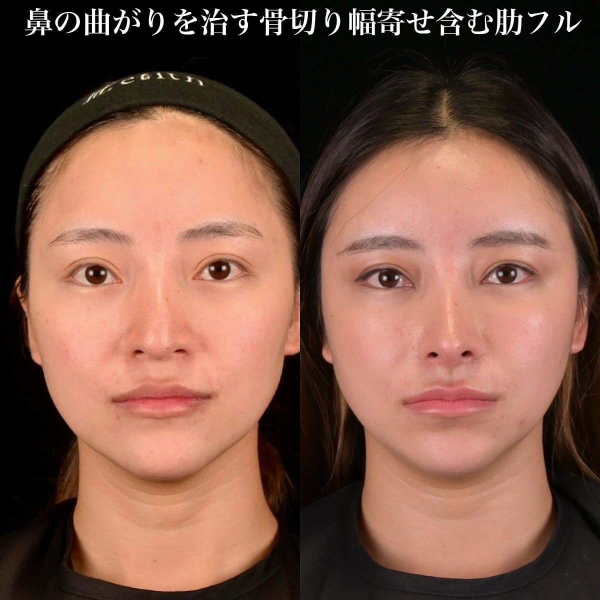 鉄医師による鼻整形の術前/術後3ヶ月