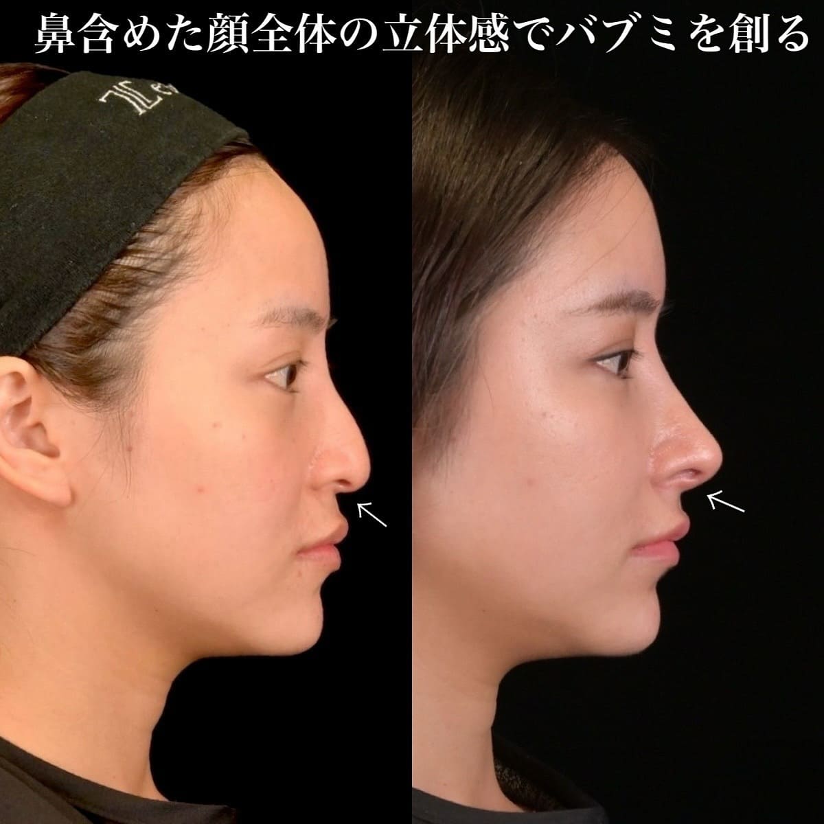 鉄医師による鼻整形の術前/術後3ヶ月 Sau 