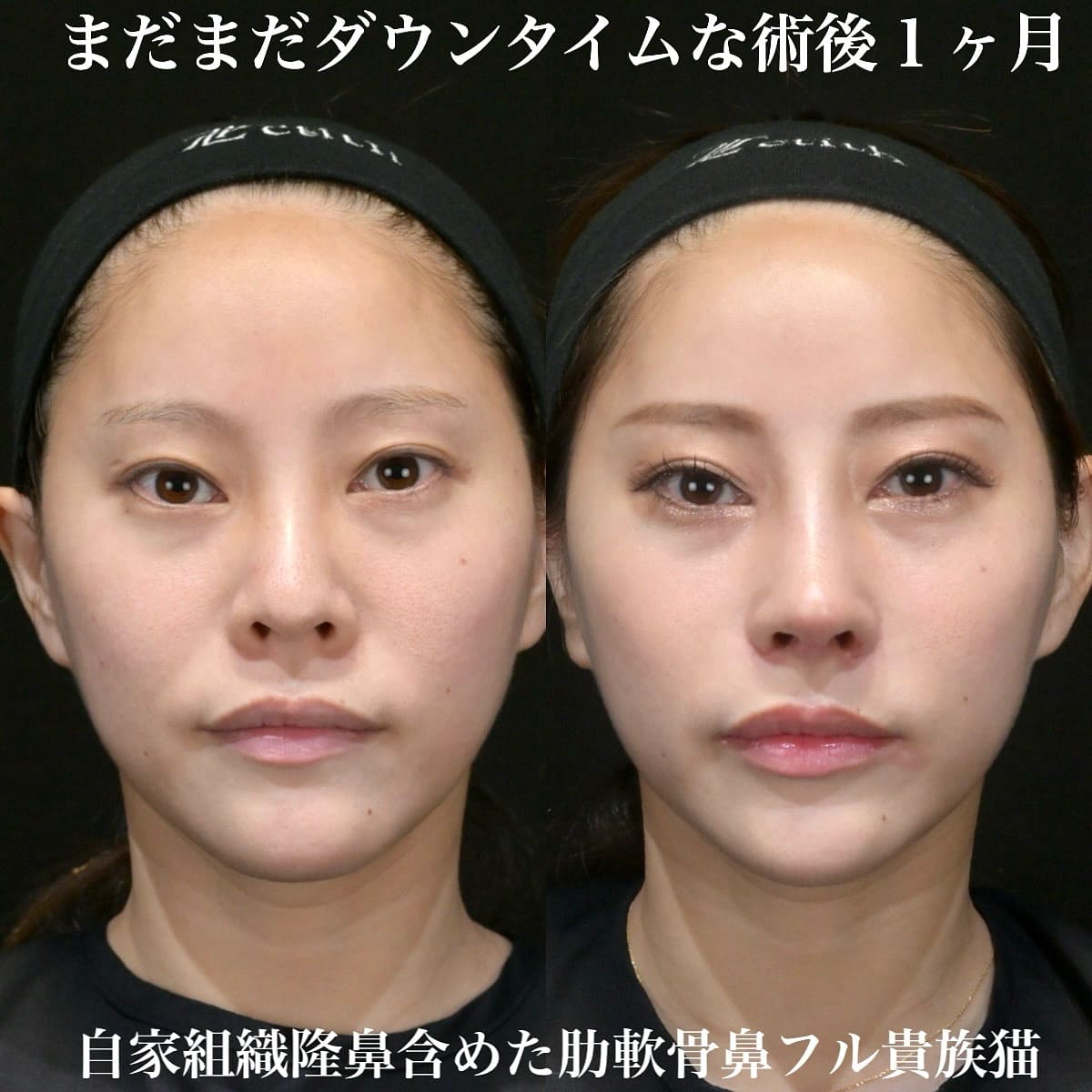 鉄医師による鼻整形の術前/術後1ヶ月
