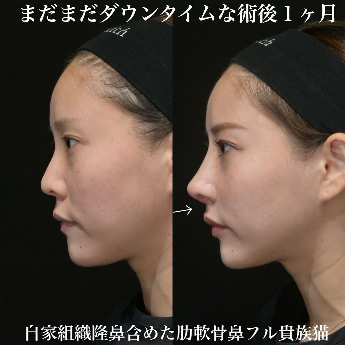 鉄医師による鼻整形の術前/術後1ヶ月 术后 