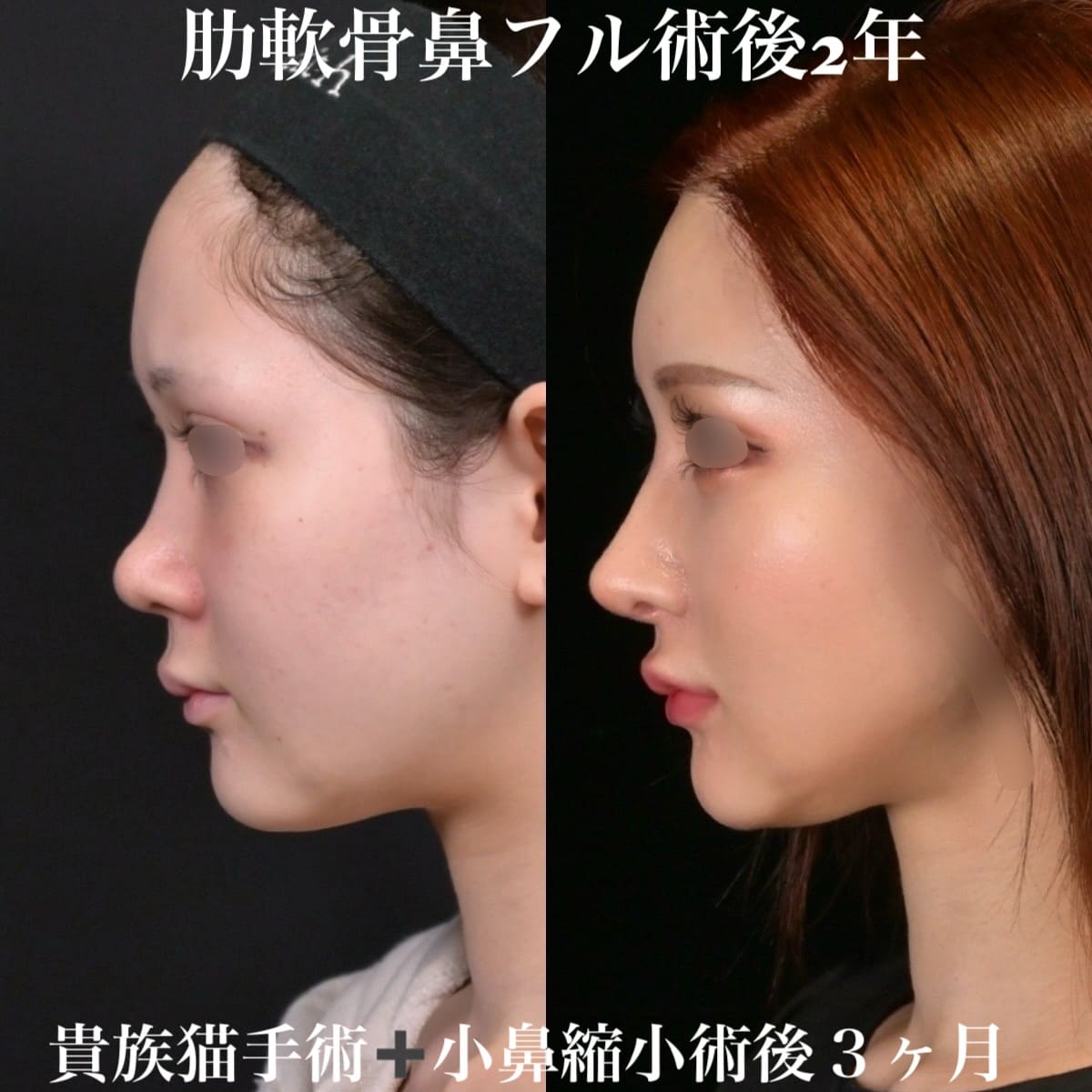 鉄医師による鼻整形の術前/術後1ヶ月 施術後 