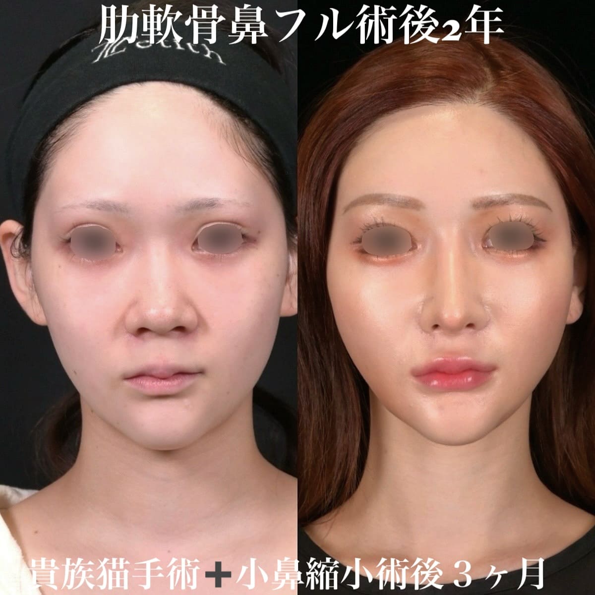 鉄医師による鼻整形の術前/術後1ヶ月