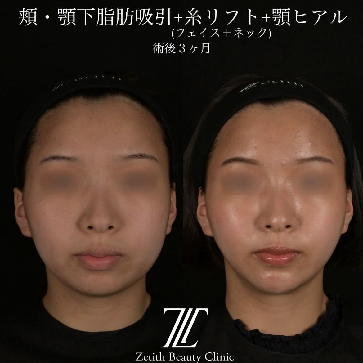 北村医師による脂肪吸引リフトの術前/術後3ヶ月