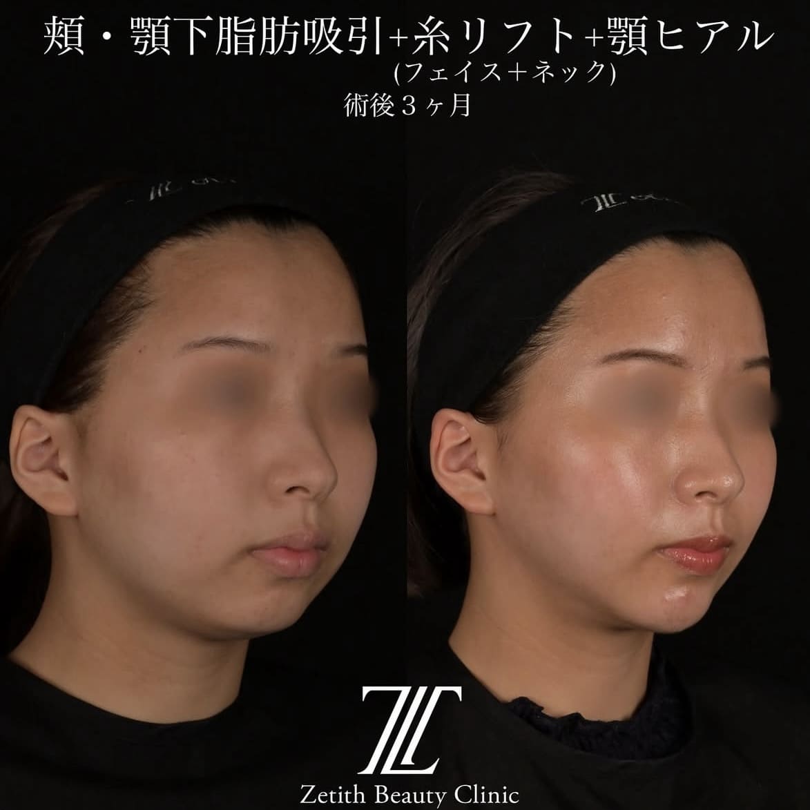 北村医師による脂肪吸引リフトの術前/術後3ヶ月 术后 