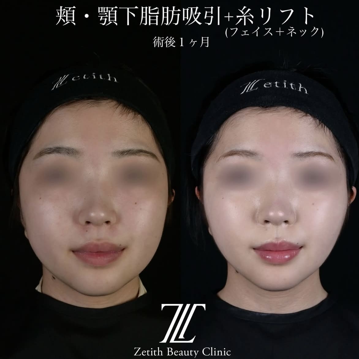 北村医師による脂肪吸引リフトの術前/術後1ヶ月