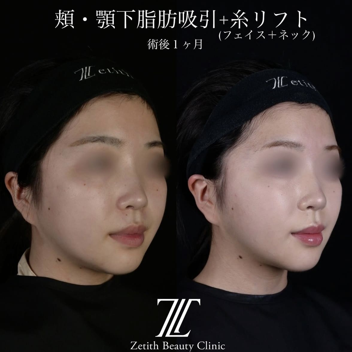 北村医師による脂肪吸引リフトの術前/術後1ヶ月 After 