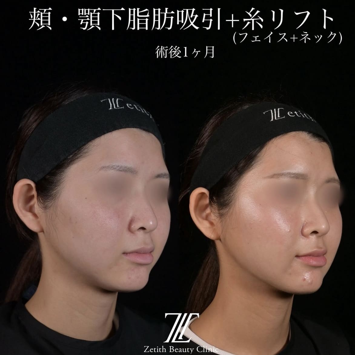 北村医師による脂肪吸引リフトの術前/術後1ヶ月 术后 