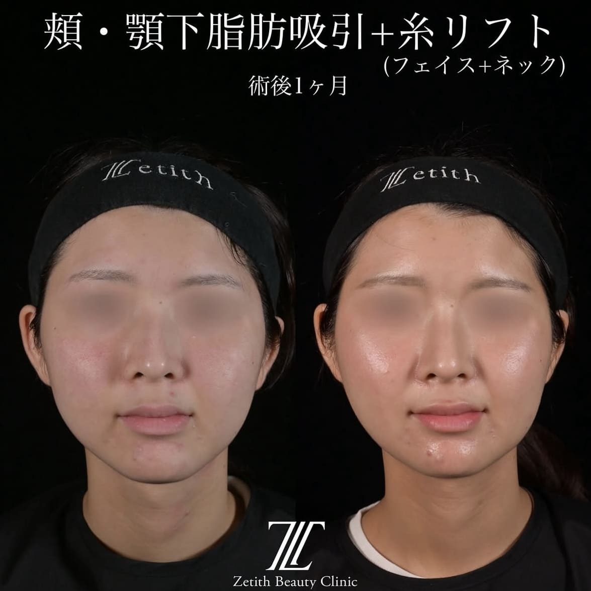 北村医師による脂肪吸引リフトの術前/術後1ヶ月