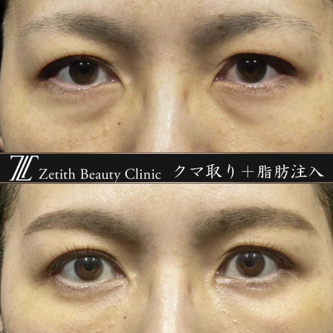 クマ治療の術前/術後1週間