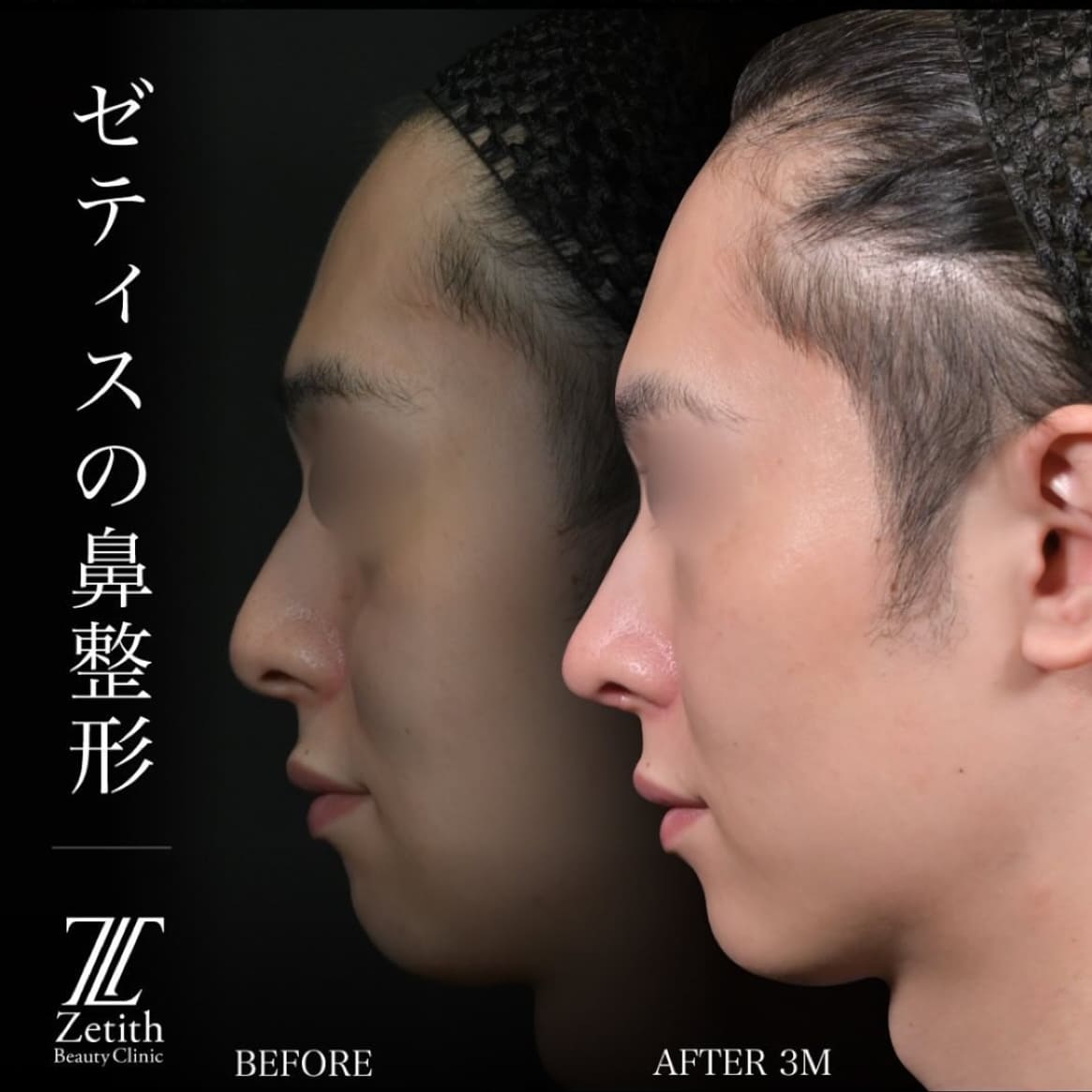 守屋医師による鼻整形の術前/術後3ヶ月