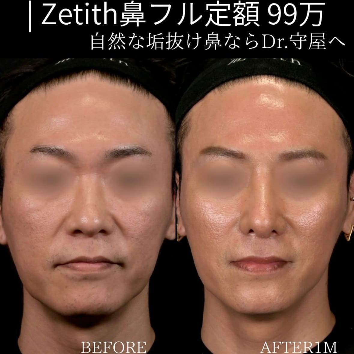 守屋医師による鼻整形の術前/術後1ヶ月