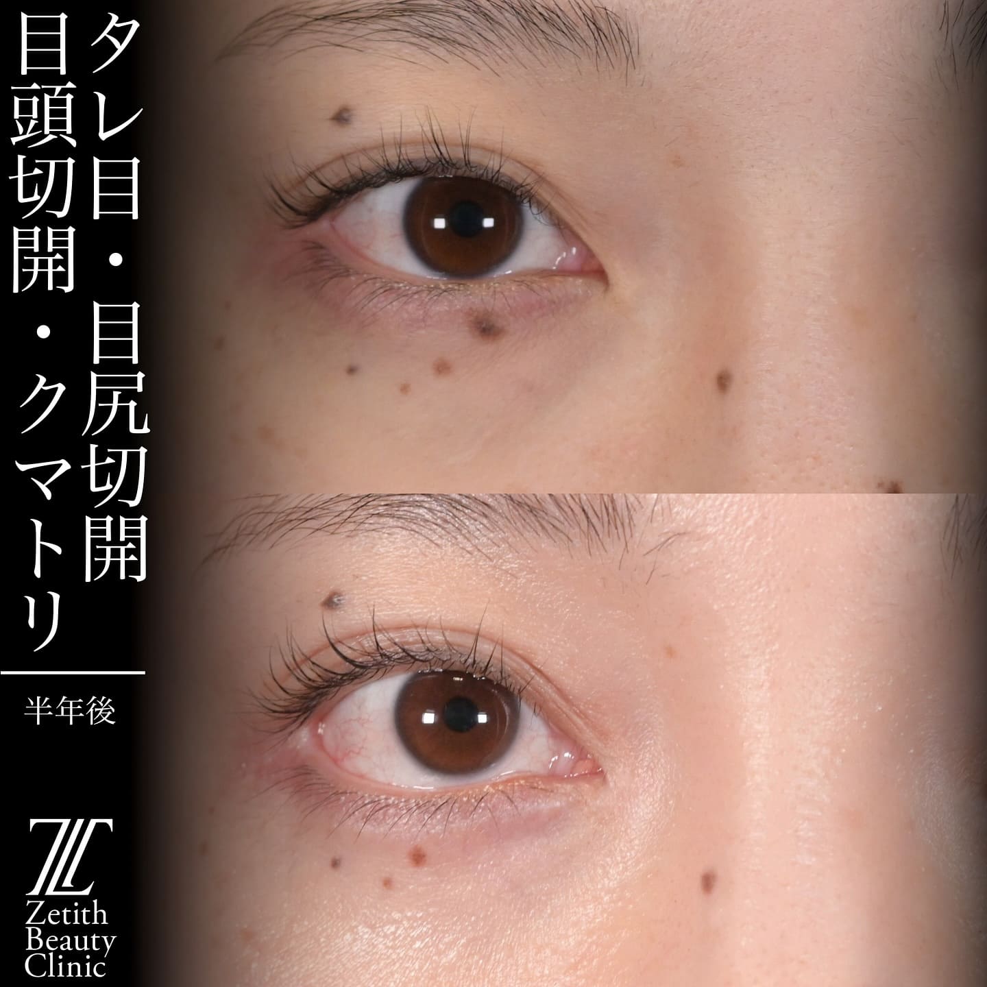 上木原医師による目元整形の術前/術後6ヶ Sonra 