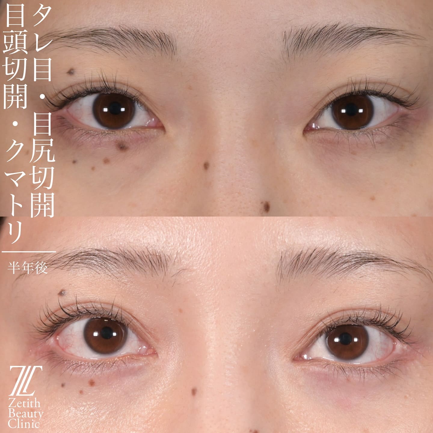 上木原医師による目元整形の術前/術後6ヶ
