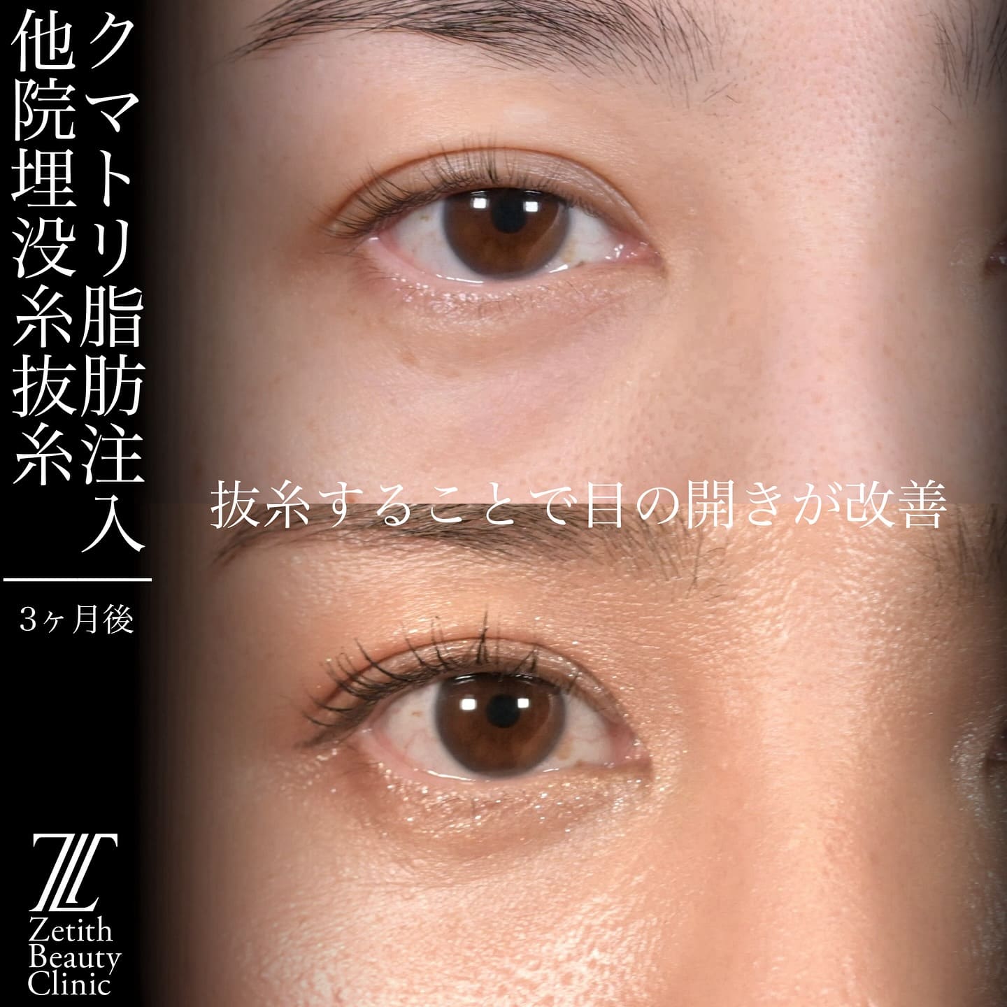 上木原医師による鼻整形の術前/術後3ヶ月 施術後 