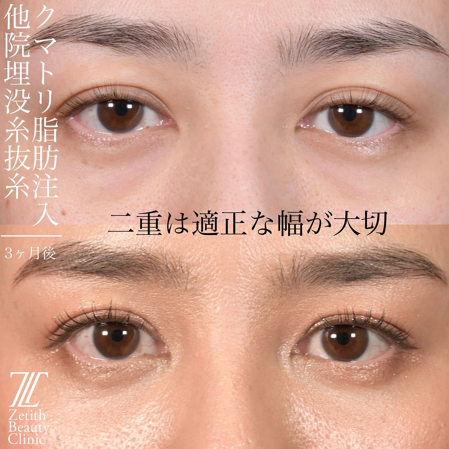 上木原医師による鼻整形の術前/術後3ヶ月