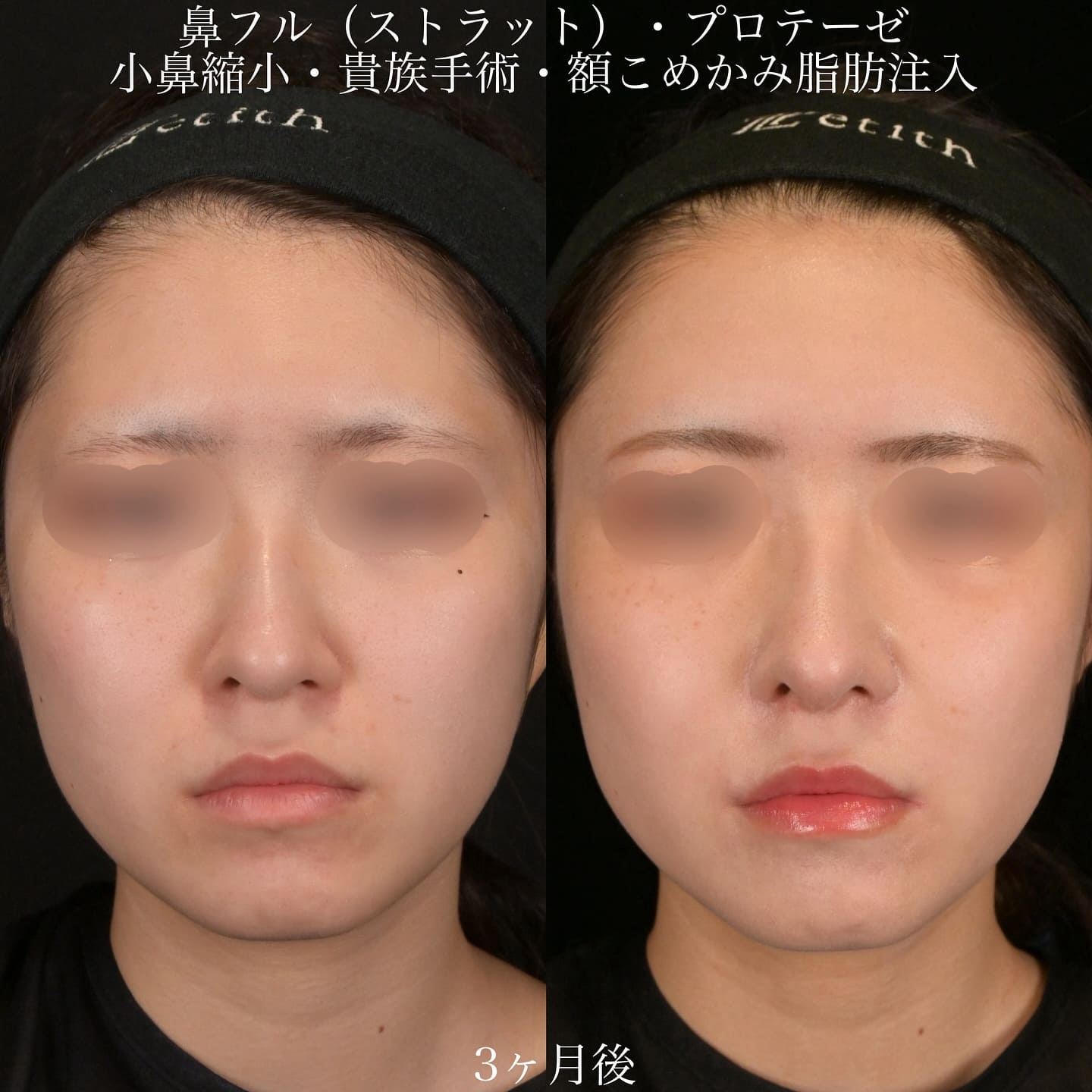 上木原医師による鼻整形の術前/術後３ヶ月