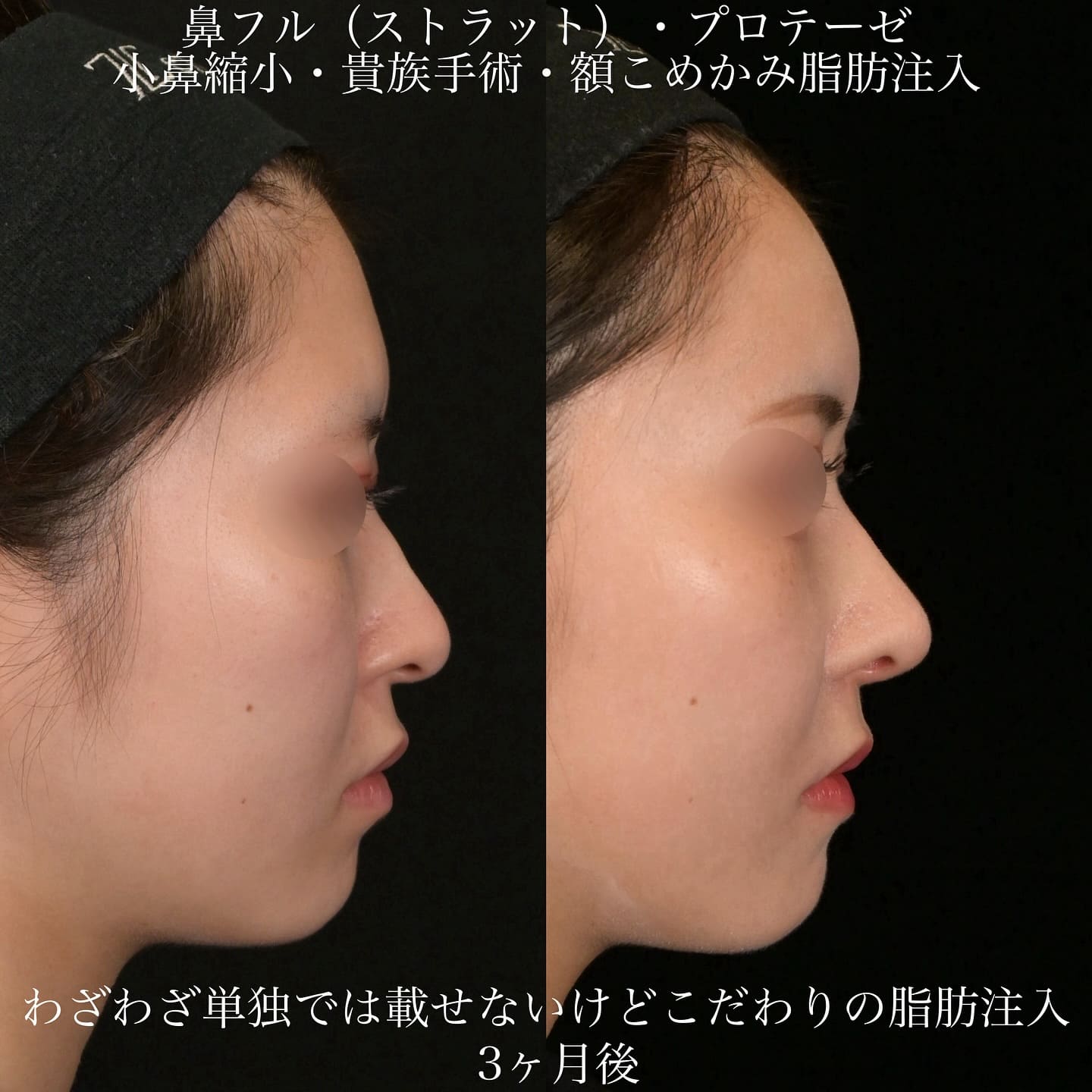上木原医師による鼻整形の術前/術後３ヶ月 Sonra 