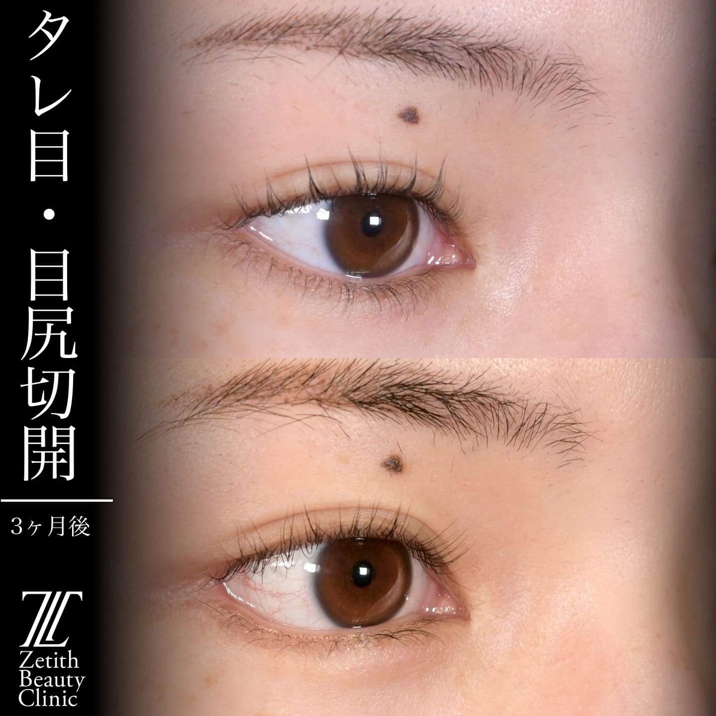 上木原医師による目元整形の術前/術後3ヶ月 术后 