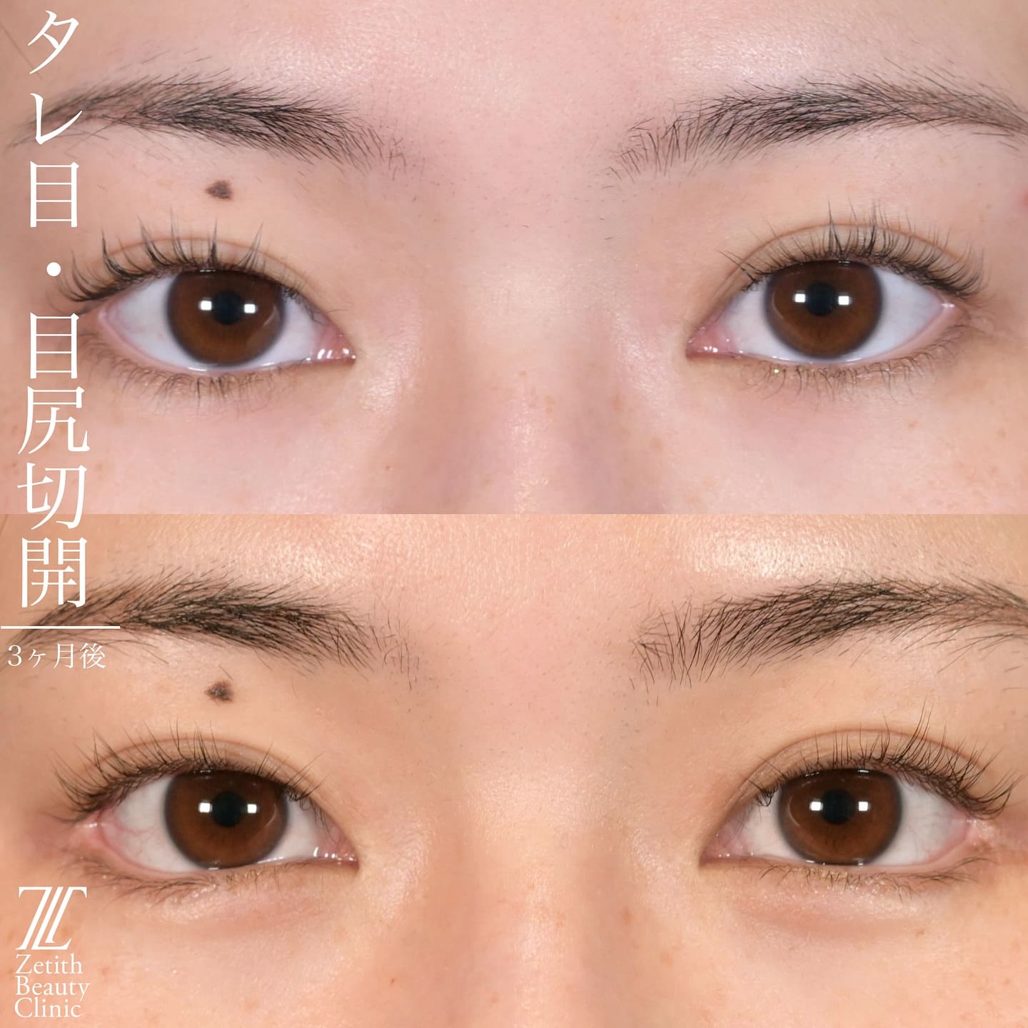 上木原医師による目元整形の術前/術後3ヶ月