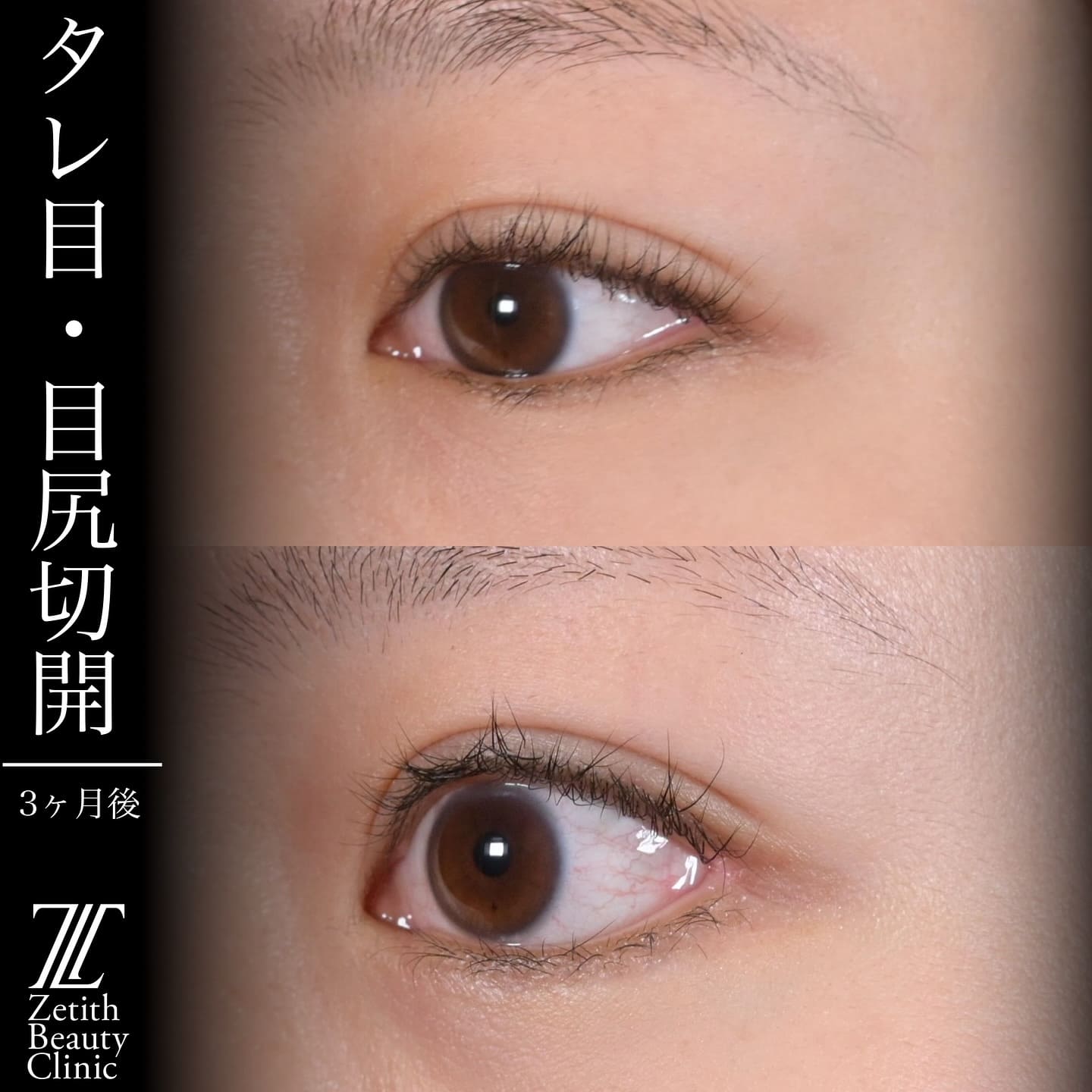 上木原医師による目元整形の術前/術後３ヶ月 施術後 