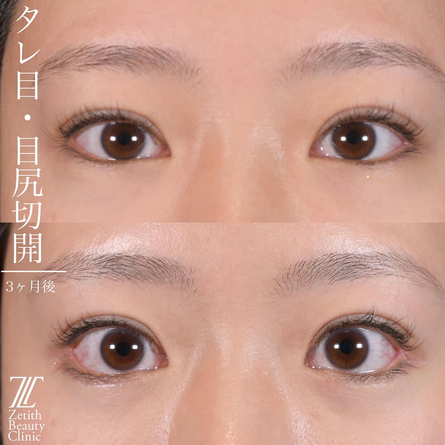 上木原医師による目元整形の術前/術後３ヶ月