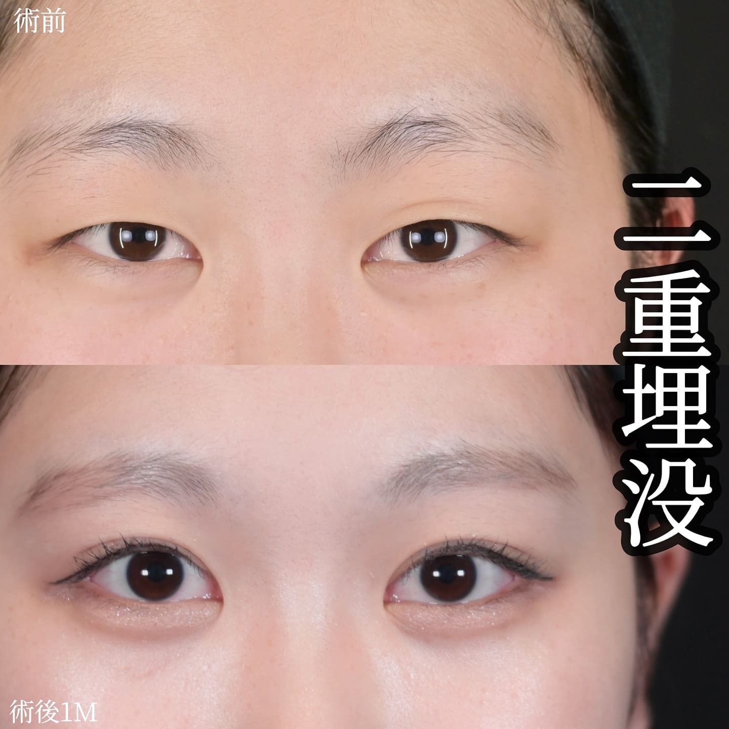 沈医師による二重整形の術前/術後1ヶ月