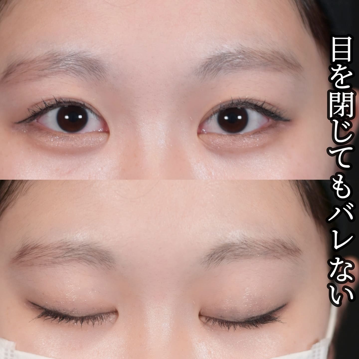 沈医師による二重整形の術前/術後1ヶ月 หลัง 