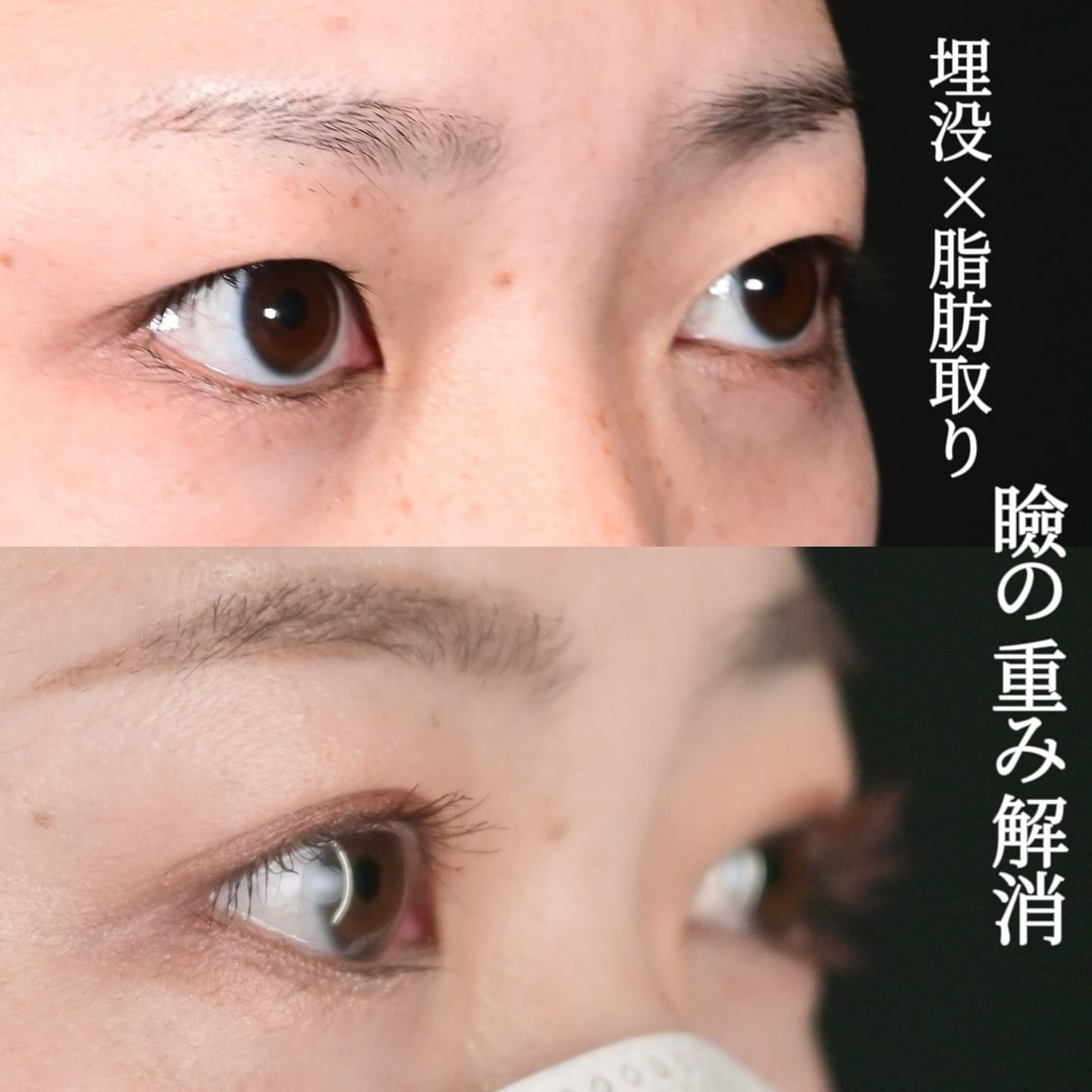 沈医師による二重整形の術前/術後1ヶ月 术后 