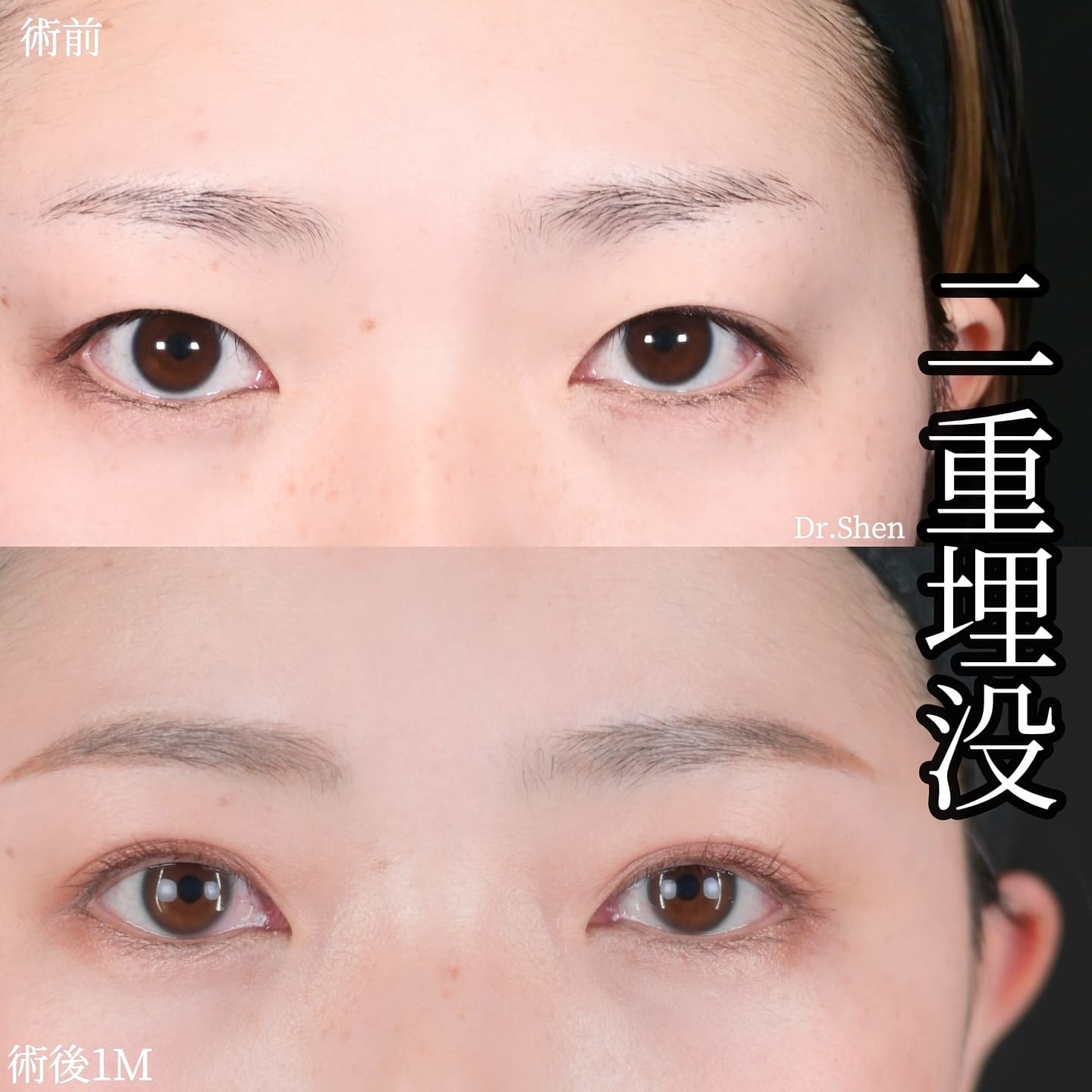 沈医師による二重整形の術前/術後1ヶ月
