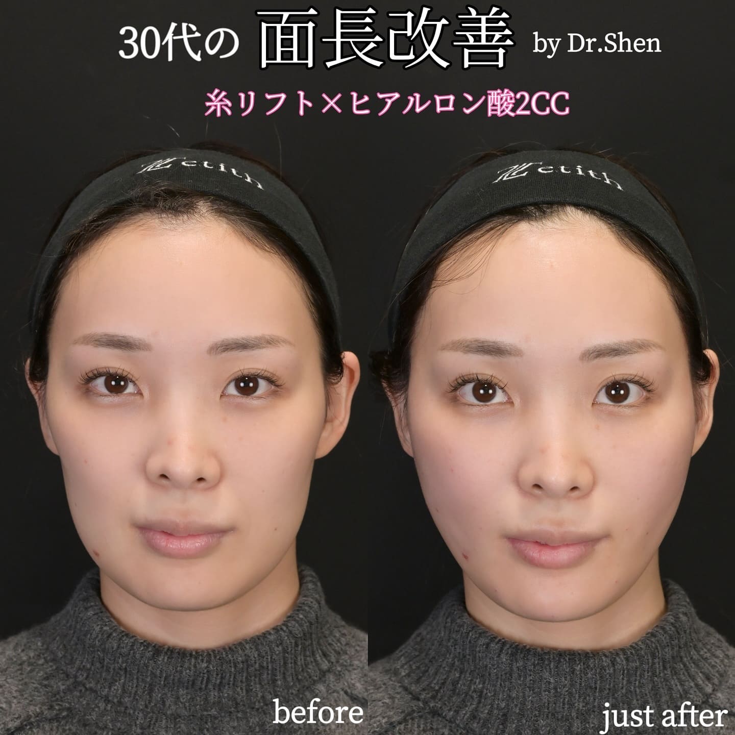 沈医師による糸リフトの術前/術直後