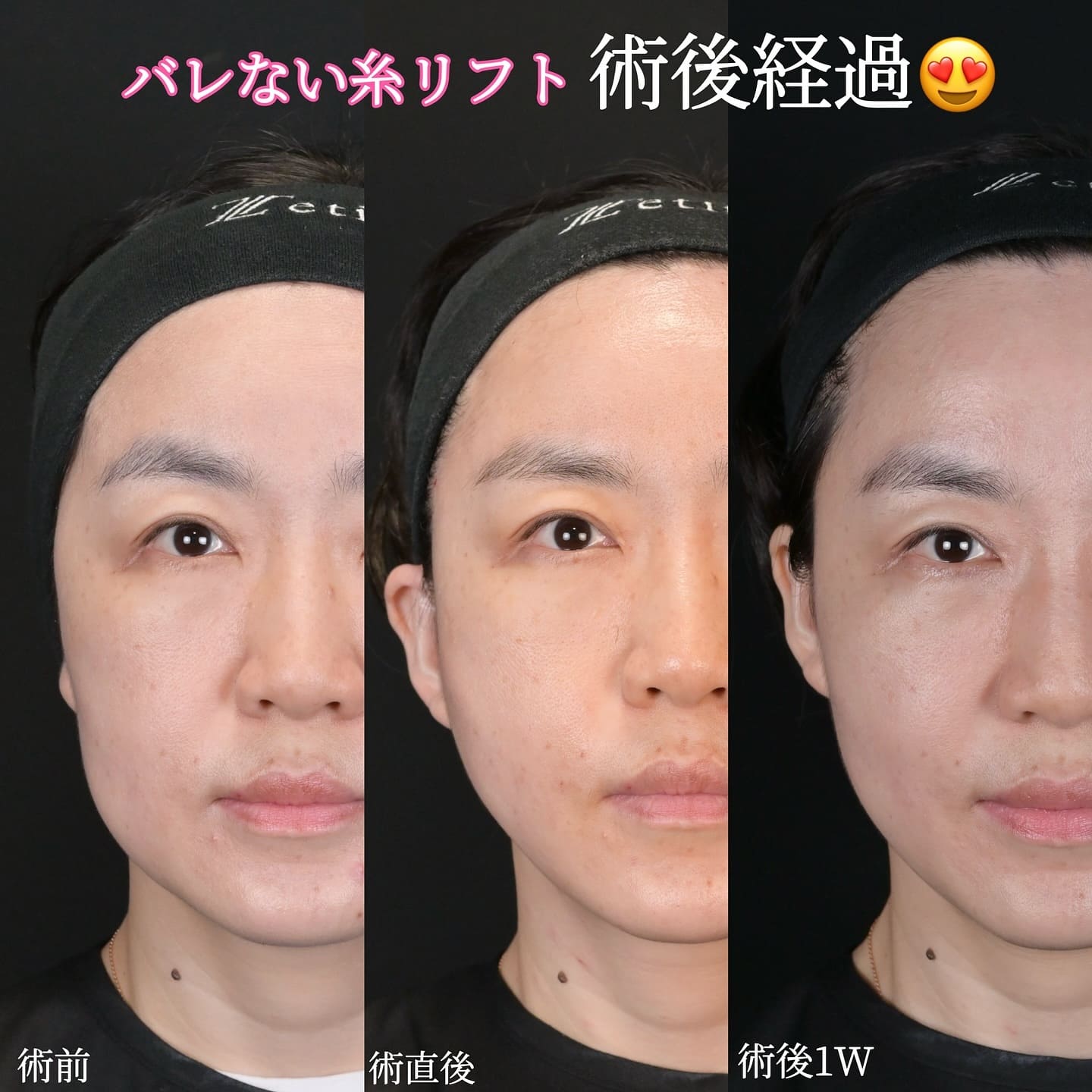 沈医師による糸リフトの術前/術後1週間 Sau 