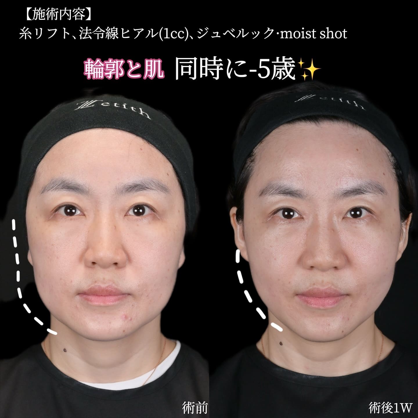 沈医師による糸リフトの術前/術後1週間