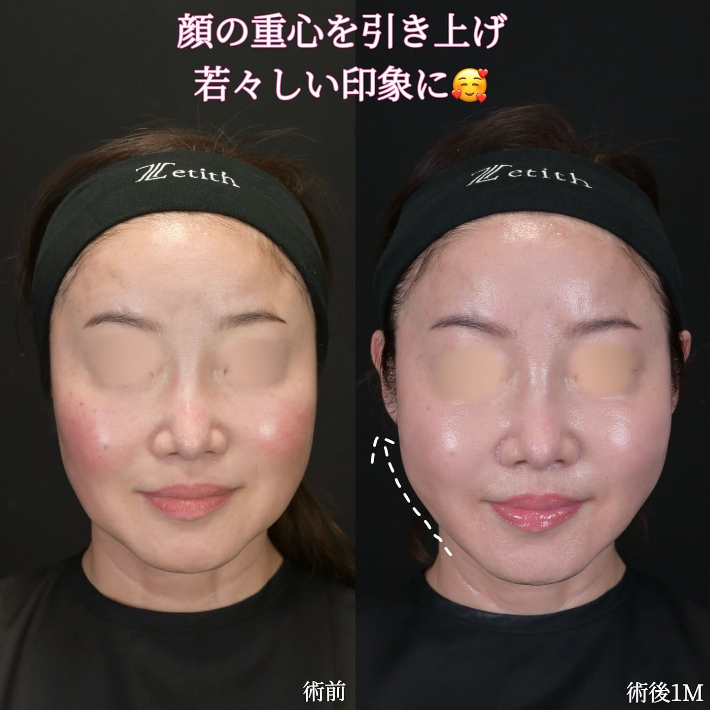 沈医師による糸リフトの術前/術後1ヶ月