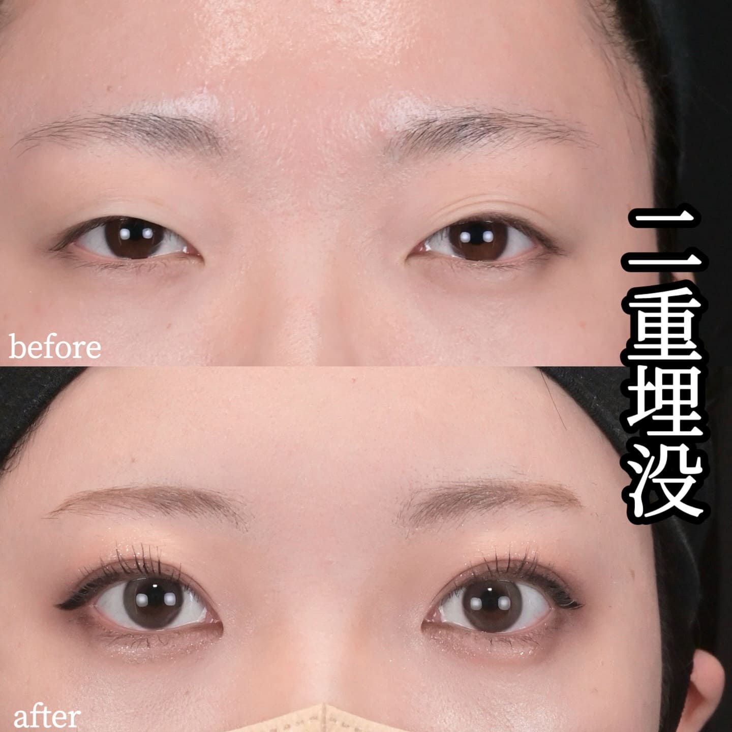 沈医師による二重整形の術前/術後1ヶ月