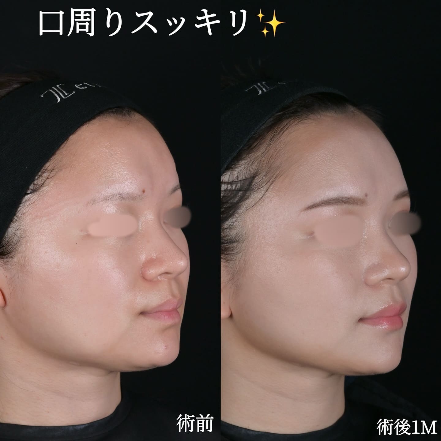 沈医師による糸リフトの術前/術後1ヶ月 หลัง 