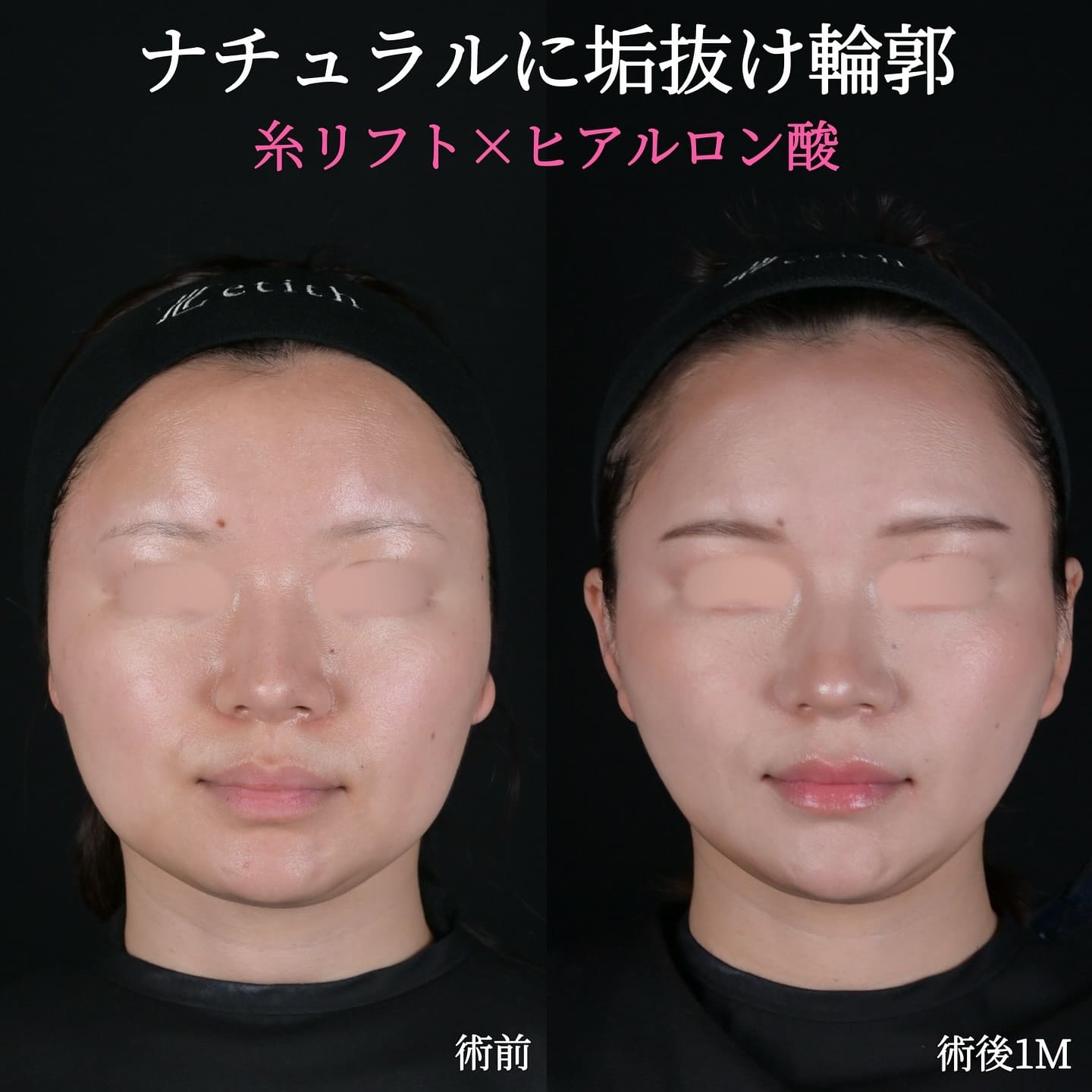 沈医師による糸リフトの術前/術後1ヶ月