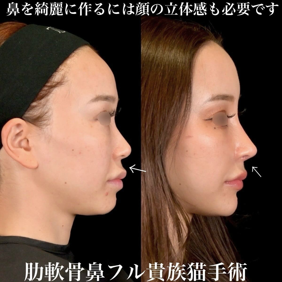 鉄医師による鼻整形の術前/術後2週間 After 