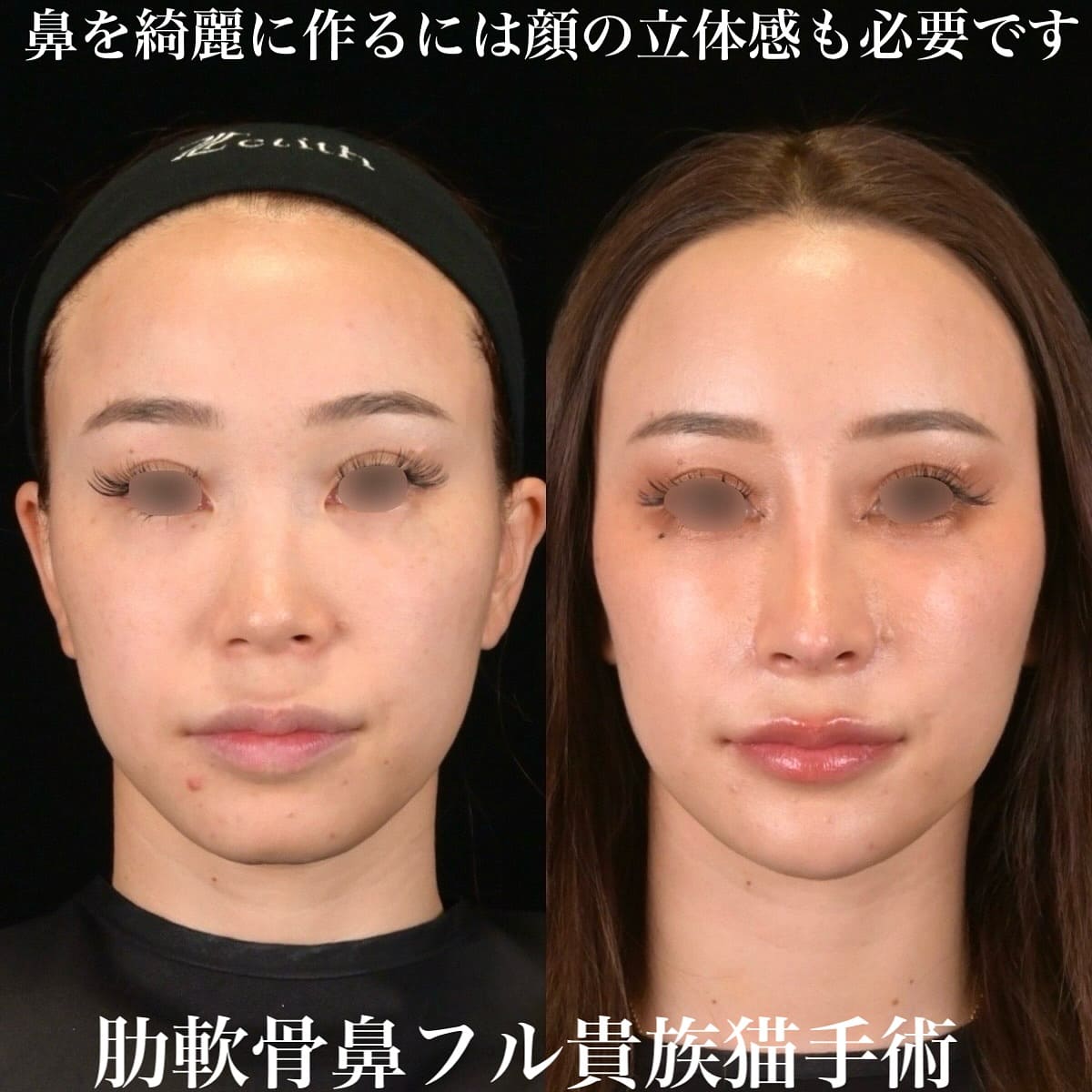 鉄医師による鼻整形の術前/術後2週間