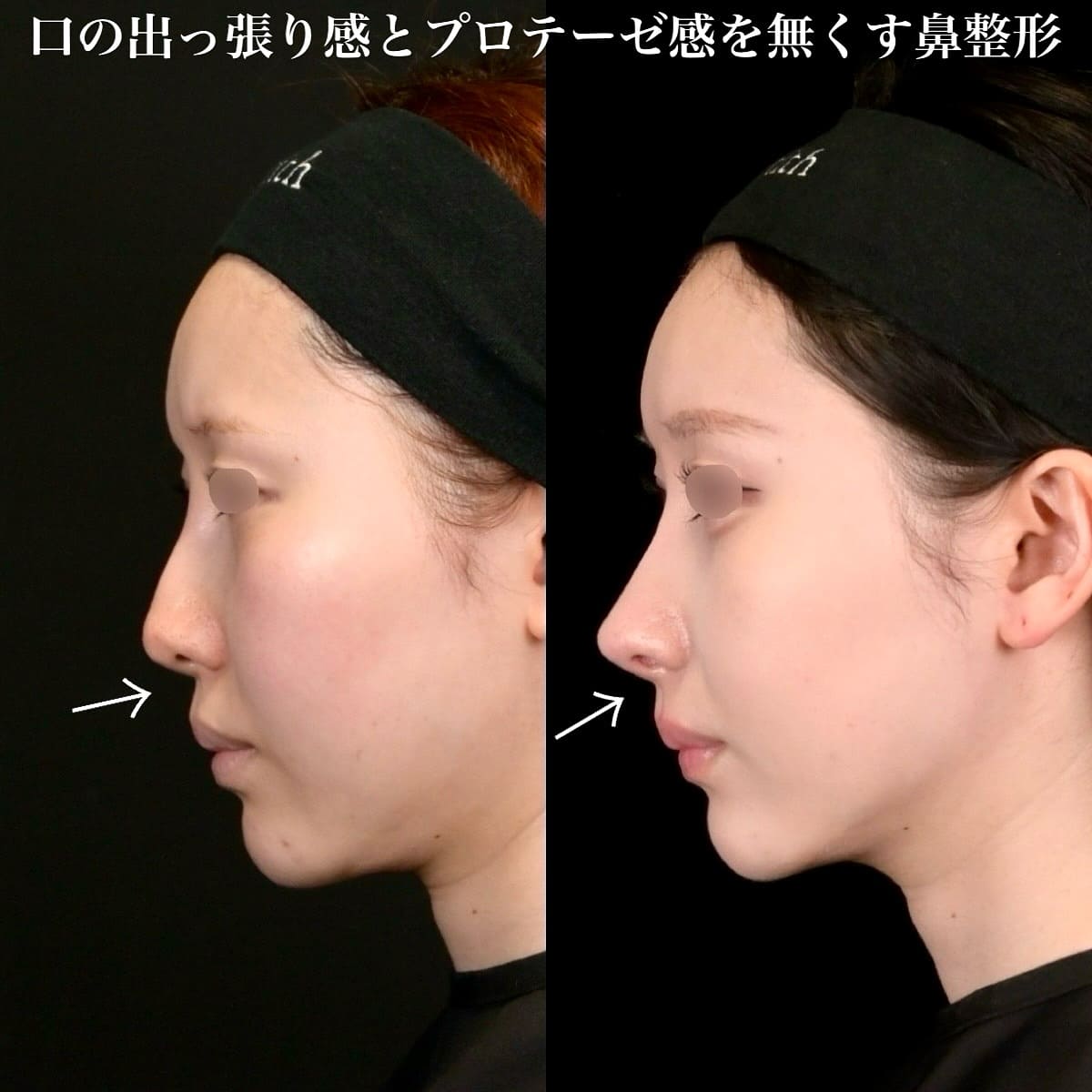 鉄医師による鼻整形の術前/術後6ヶ月 施術後 