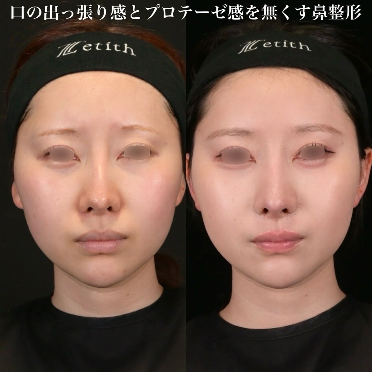 鉄医師による鼻整形の術前/術後6ヶ月